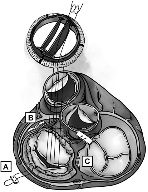 Systematic Approach To The Calcified Mitral Valve Apparatus At Time Of