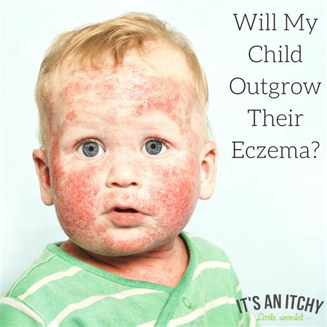 “will My Child Outgrow Their Eczema” A Clinical Perspective Of The