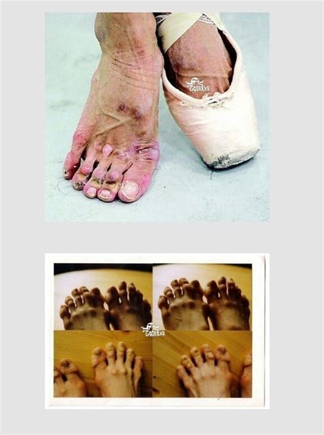 Ballet Feet Before And After Outlet
