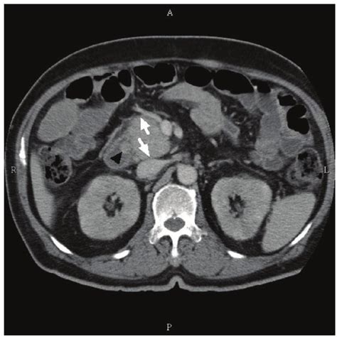 Contrast Enhanced Abdominal Computed Tomography Displaying A 1 Cm