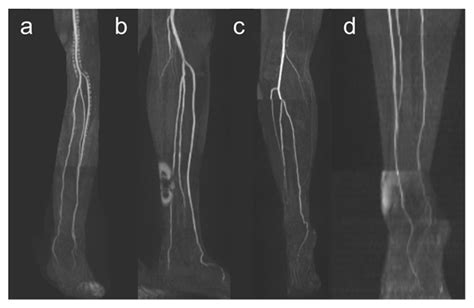 Jcm Free Full Text Evaluation Of Lower Leg Arteries And Fibular