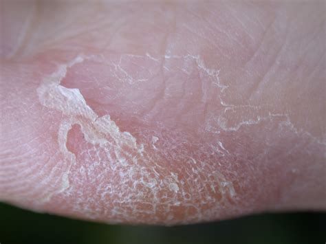 Imageafter Textures Skin Texture Pink Macro Flesh Blister Foot
