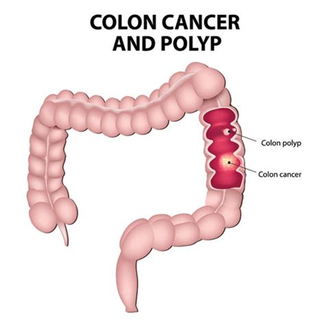 Sometimes the polyps look like stalks of cauliflower, sometimes they're flat, said dr. Cologuard: A New Test For Reducing The Risk Of Colon ...