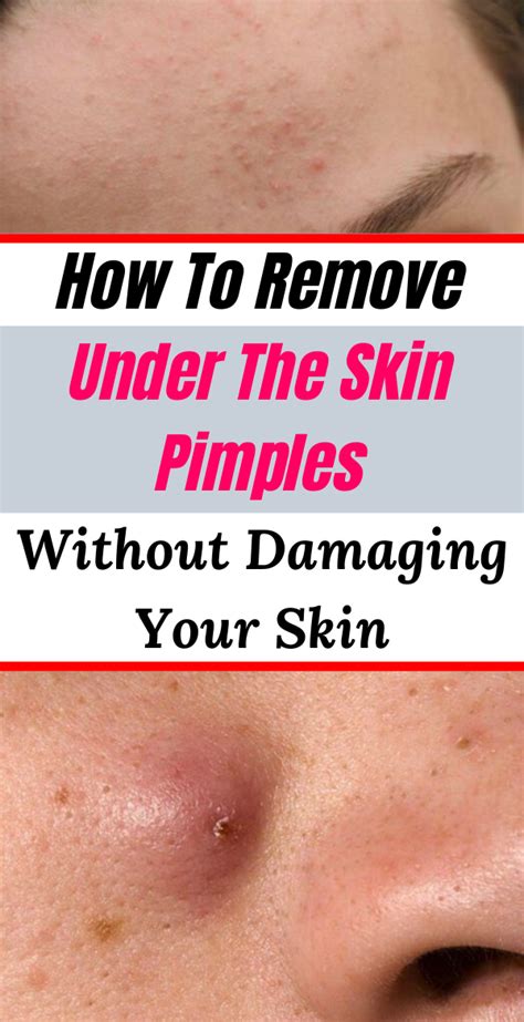 How To Remove Under The Skin Pimples Without Damaging Your Skin Only Tips