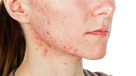 What Is Fungal Acne Causes Treatments And Symptoms Allure