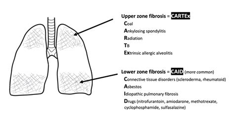 Pulmonary Fibrosis Oscestop Osce Learning