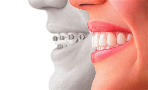 A Guide To Invisible Braces The Dental Guide Uk