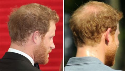 Is Prince Harry Going Bald Princes Scalp Visible As He Steps Out With