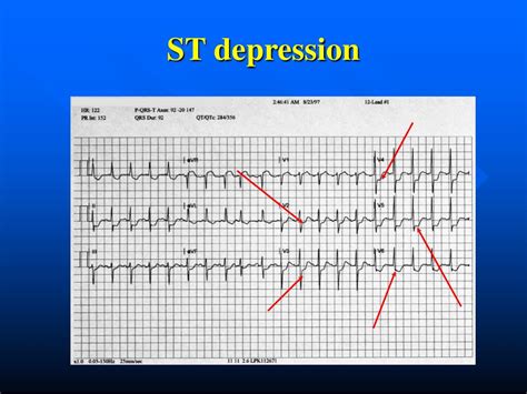 Ppt 12 Lead Ekg 101 Powerpoint Presentation Free Download Id3223309