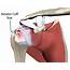 Relief From Rotator Cuff Injuries Using Acupuncture