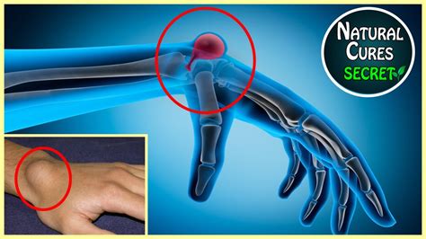 How To Get Rid Of Ganglion Cysts Naturally At Home Painful Bump On