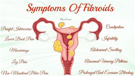 Fibroids Miracle™ Review Fibroid Uterus Uterine Fibroids Symptoms