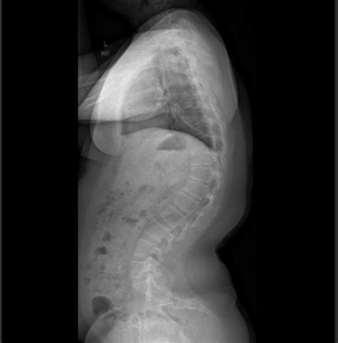 My Schuerrmanns Kyphosis X Ray Thought Yall Would Enjoy This R