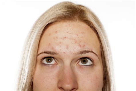 What Is My Skin Type Dermatologist Guide Acne Help Mdacne