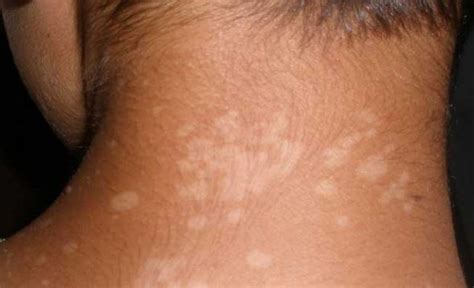 7 Common Causes Of White Spot On Your Skin Md