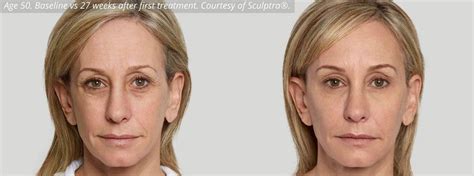 Vancouver Sculptra® Aesthetic For Non Invasive Face Lifts In Surrey