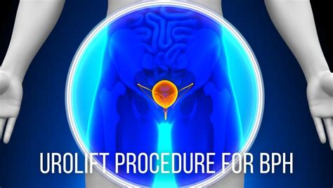 Bph Enlarged Prostate Advanced Urology Institute