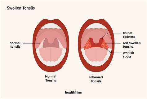 Swollen Tonsils Tonsillitis Symptoms Causes And More Swollen