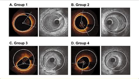 Representative Optical Coherence Tomography And Intravascular