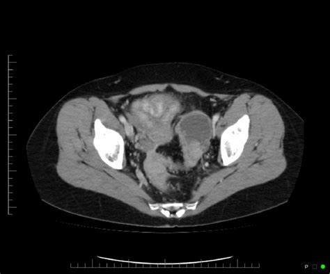 Figure 2 From Imaging Of Primary Carcinoma Of The Fallopian Tube
