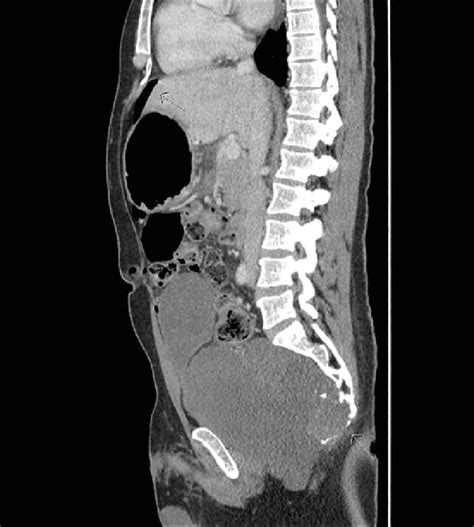 Ct Abdomen And Pelvis Sagittal View With Iv Contrast Showed Free