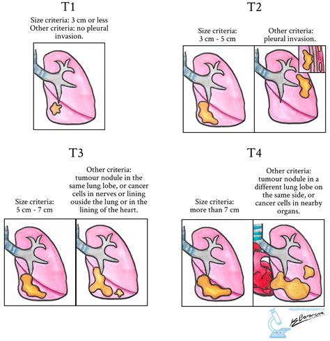 Adenocarcinoma Of The Lung Mypathologyreportca
