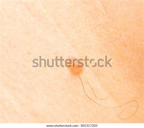 Closeup View Man Mole Ingrown Hair Foto De Stock 305317205 Shutterstock