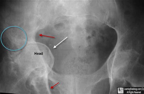 Learningradiology Acetabular Protrusio Acetabuli Paget Hip Radiology