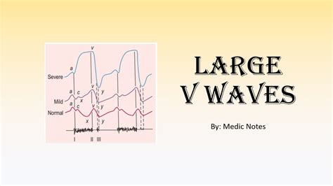 Large V Waves Definition Causes Pathophysiology Youtube