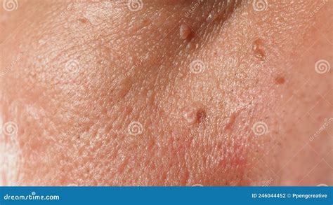 Wart Skin Removal Macro Shot Of Warts Near Eye On Face Stock Photo