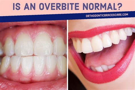 We did not find results for: Is An Overbite Normal? How To Diagnose It? | Orthodontic ...