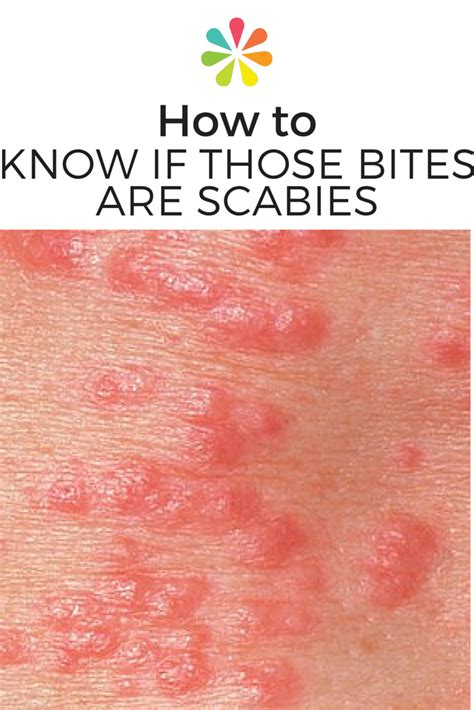 What Does Scabies Look Like On Face What Does