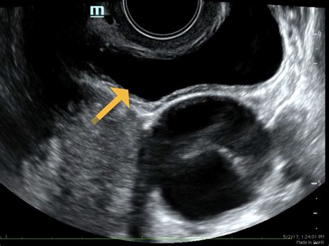 Point Of Care Ultrasound For The Diagnosis Of Ovarian And Fallopian