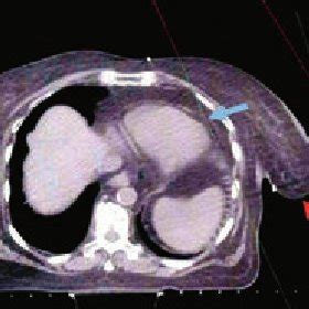 Pendulous Breast Left Side Note Drooping Breast Laterally Red