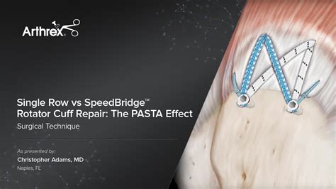 Arthrex Single Row Vs Speedbridge Rotator Cuff Repair The Pasta Effect