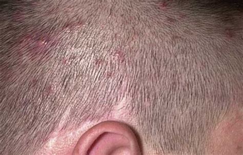 Pimples On Head Causes Treatment And Remedies Skincarederm