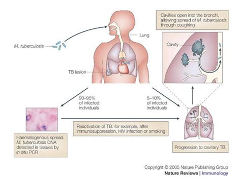 Tuberkulose 2 Pathophysiologie Und Mikrobiologie Der Lungentuberkulose