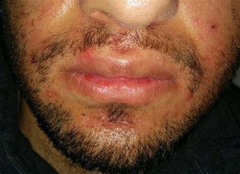 Pics Attached Do I Have Folliculitis Or Perioral Dermatitis Or Just