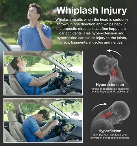 Whiplash And How To Treat It