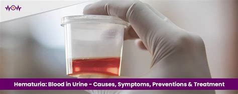 Hematuria Blood In Urine Causes Symptoms Preventions Treatment