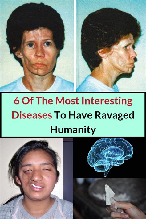 6 Of The Most Interesting Diseases To Have Ravaged Humanity Disease
