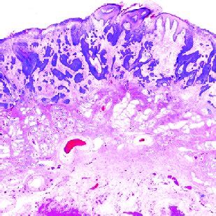 Progression Of Cpv Induced Viral Papilloma To Epidermal Dysplasia