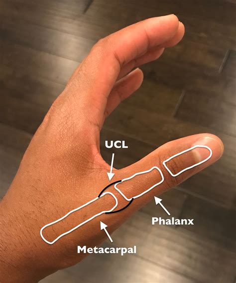 Unraveling The Ucl Injury Of The Thumb