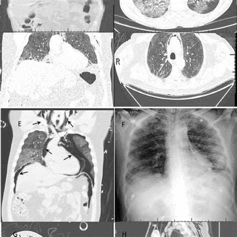 Chest Ct Scans Or Radiograph Of The Chest Showing Pneumomediastinum