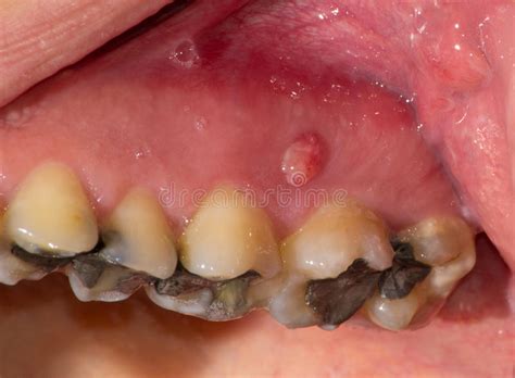 Severe Gingivitis Stock Image Image Of Mouth Abscess 27276699