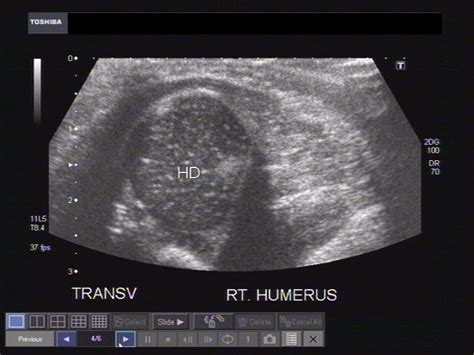 Cochinblogs Ultrasound Imaging Of The Head Of Neonatal Femur And Humerus