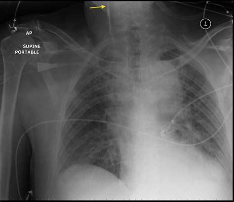 Malpositioned Subclavian Line Radiology At St Vincents University