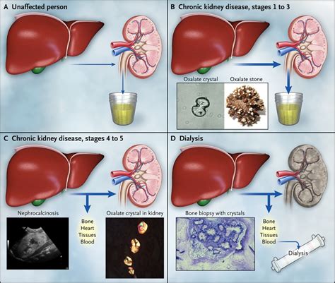 Primary Hyperoxaluria Nejm