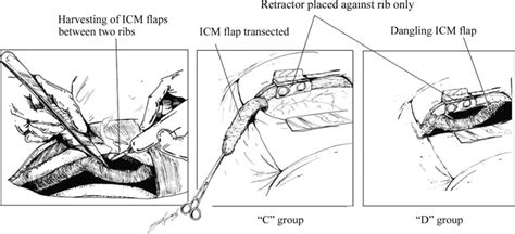 A Nondivided Intercostal Muscle Flap Further Reduces Pain Of
