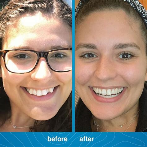 Invisalign Before And After Photosdr Jacquie Monroe Ortho